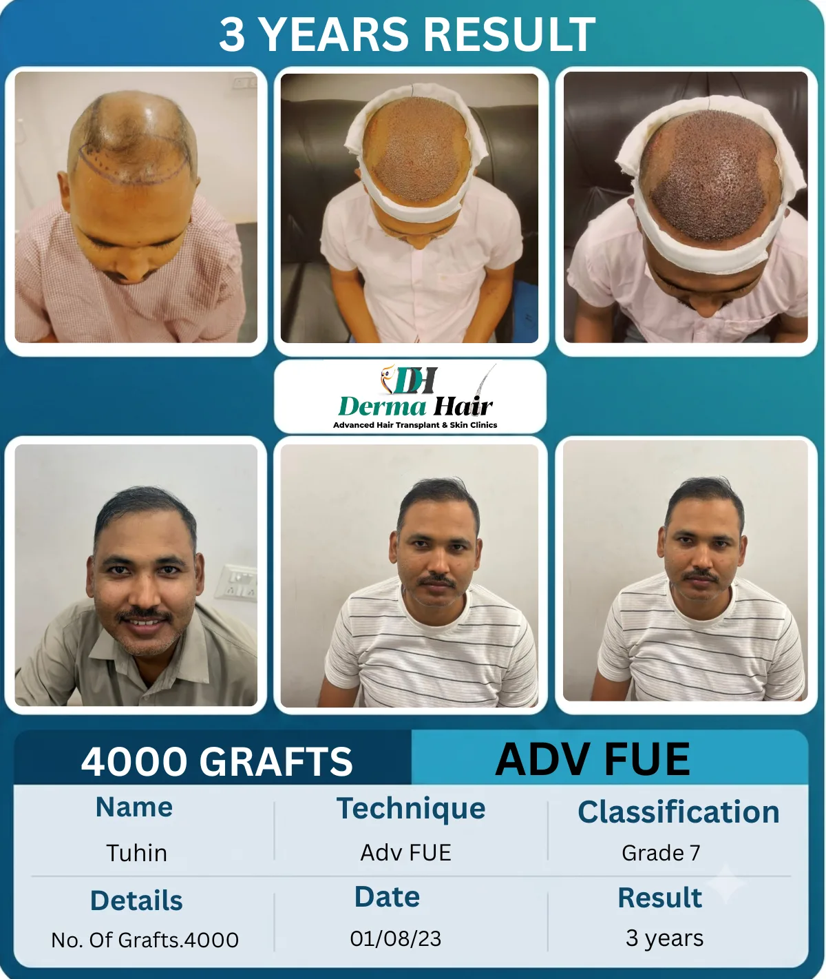 Tuhin 4000 graft Advanced FUE hair transplant before and after, 3 years result