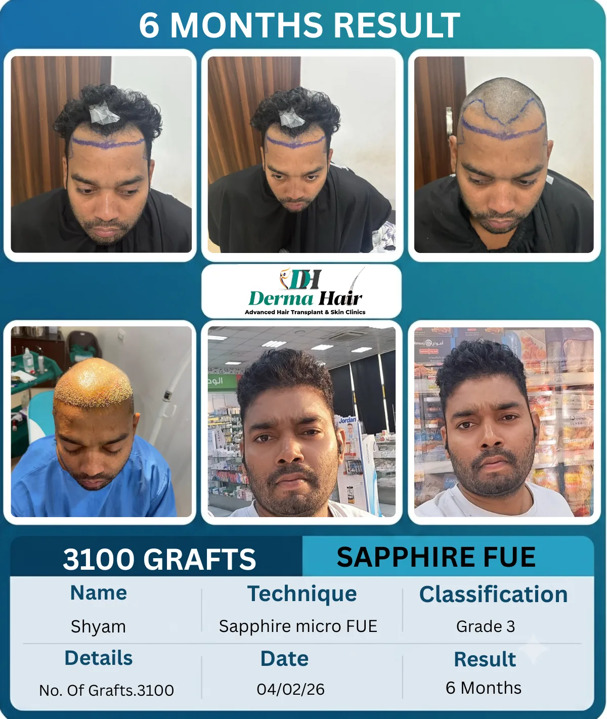 Shyam 3100 graft Sapphire micro FUE hair transplant before and after, 6 months result